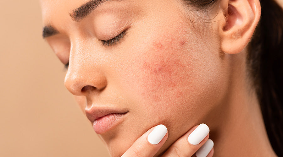 Visage femme peau sensible avec des rougeurs sur fond beige ium